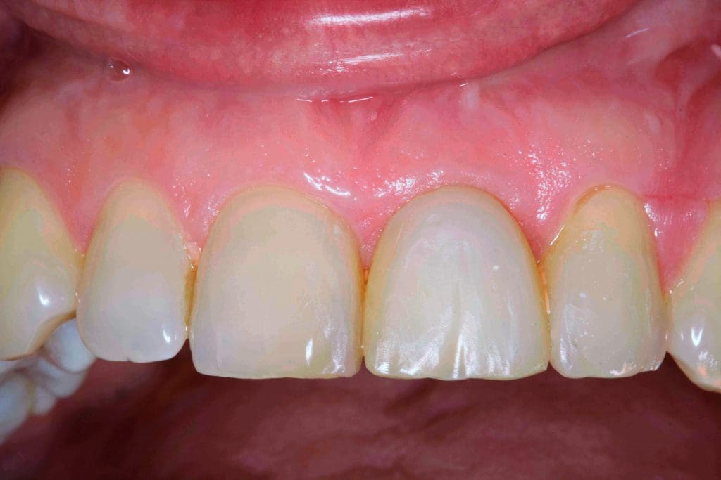 After image