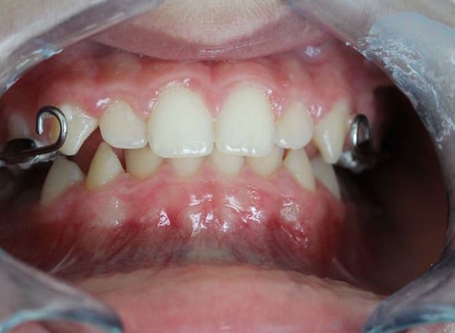 After image